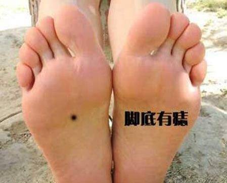 很難得！女人身上的5顆「福痣」千年修來的福 「好命又有財」千萬不要點掉